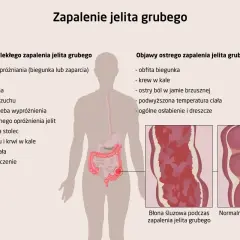 Ilustracja przedstawia objawy zapalenia jelita grubego, w tym bóle brzucha, biegunkę, krew w kale i osłabienie. Pokazuje też porównanie błony śluzowej jelita zdrowego i zmienionej zapalnie.
