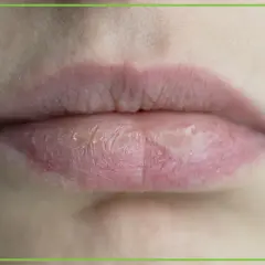 Suche usta, popękane i łuszczące się, mogą świadczyć o braku witaminy.