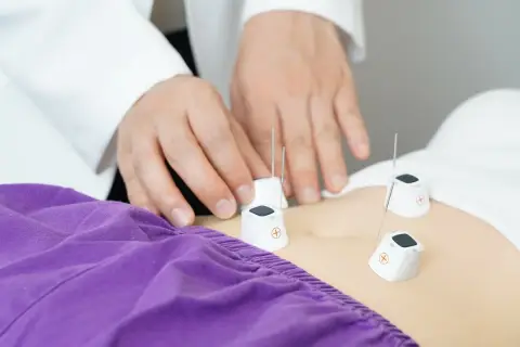 Terapeuta umieszcza igły akupunkturowe na brzuchu pacjenta. Zobacz, co daje akupresura.