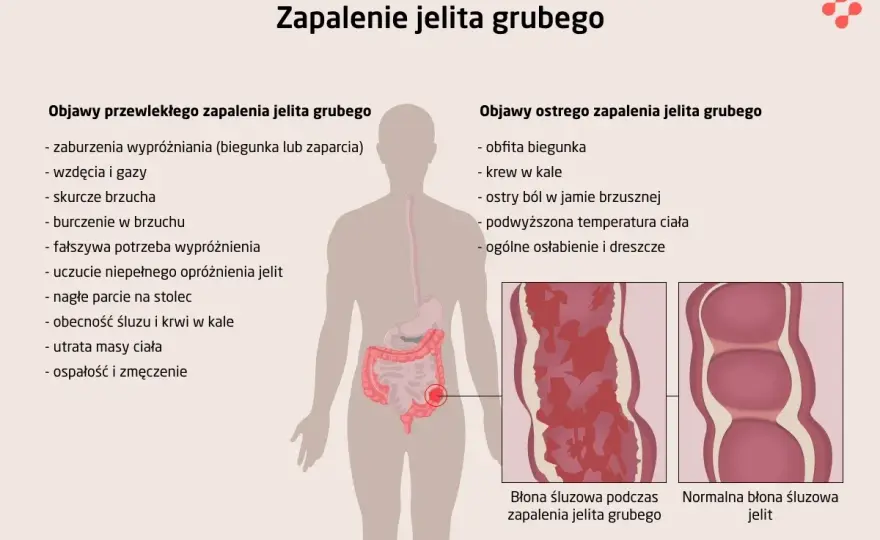 Stan zapalny jelit - jak rozpoznać i co naprawdę pomaga