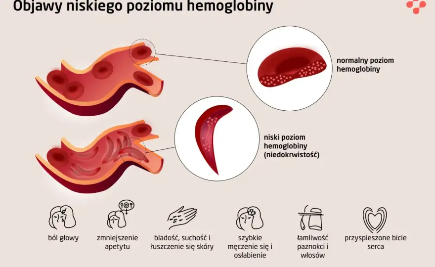 Hipoproteinemia - co oznacza niski poziom białka we krwi?