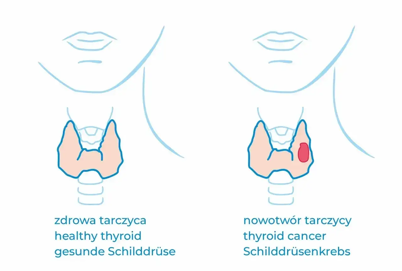 Porównanie zdrowej tarczycy z nowotworem. Kalcytonina co to? Hormon ten jest markerem niektórych nowotworów tarczycy.