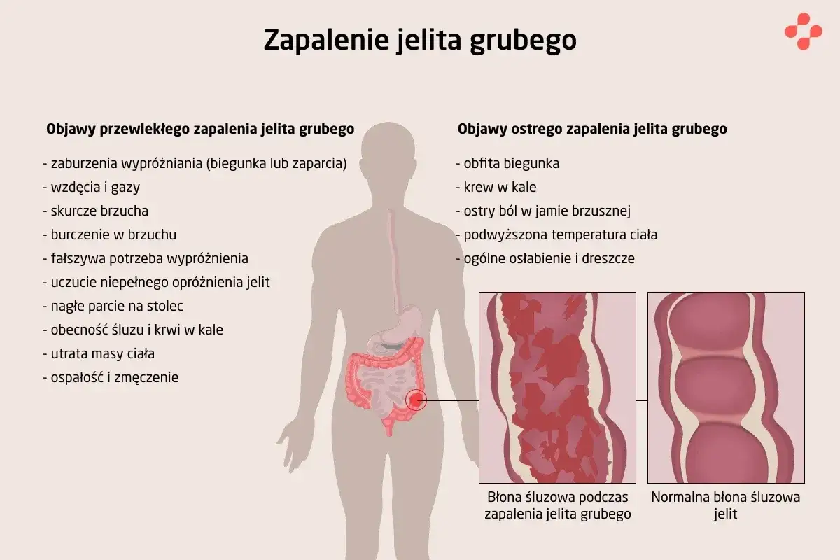 Ilustracja przedstawia objawy zapalenia jelita grubego, w tym bóle brzucha, biegunkę, krew w kale i osłabienie. Pokazuje też porównanie błony śluzowej jelita zdrowego i zmienionej zapalnie.
